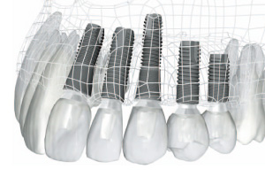 インプラント治療