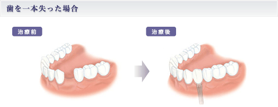 歯を一本失った場合