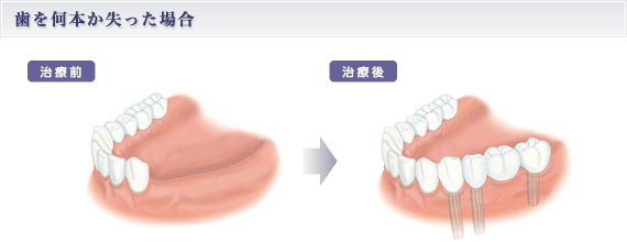 歯を何本か失った場合
