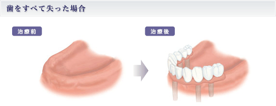 歯をすべて失った場合